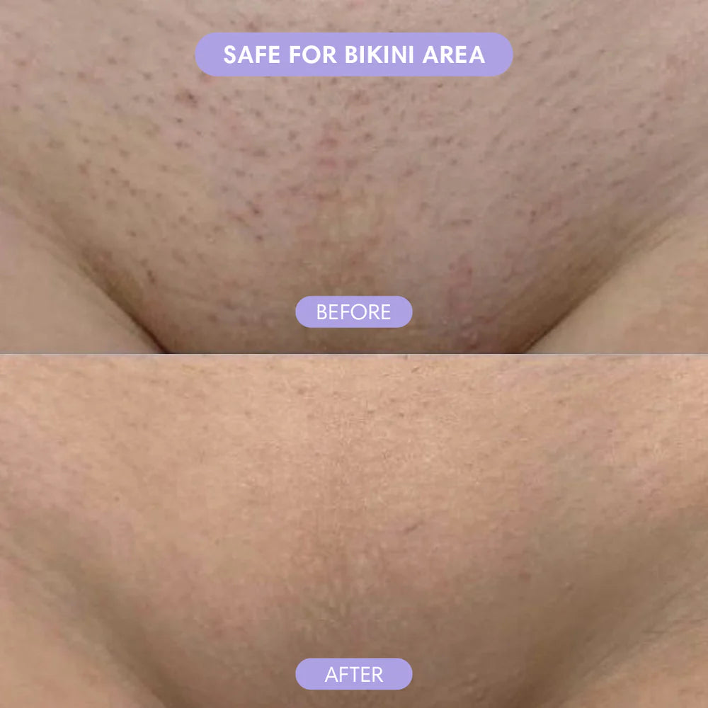 Shave armpits, legs, face and bikini area - without painful waxing or razor cuts ever again!