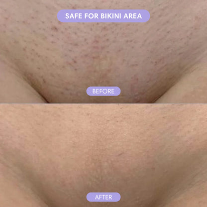 Shave armpits, legs, face and bikini area - without painful waxing or razor cuts ever again!